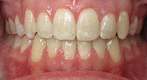 crowding of the teeth after