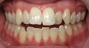 crowding of the teeth before
