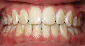 crowding of the teeth after