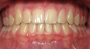 crowding of the teeth after