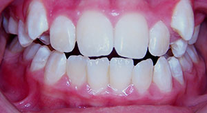 crowding of the teeth before