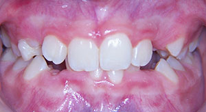 crowding of the teeth before