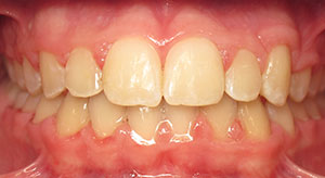 underbite after