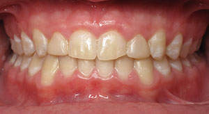 deep overbite after