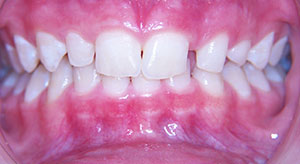deep overbite before