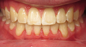deep overbite after