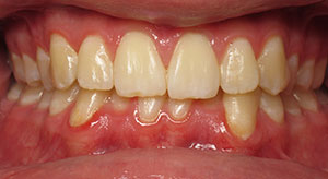 deep overbite before