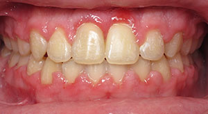 underbite after