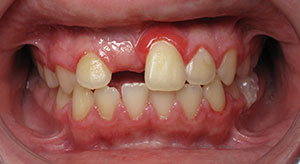 underbite before