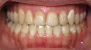 underbite after