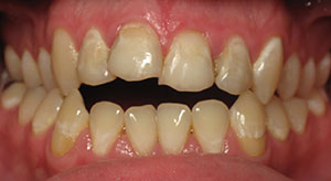 underbite before