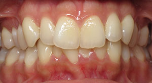 underbite before