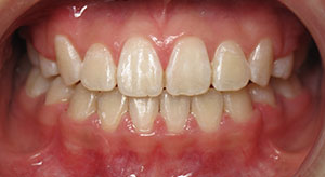 crowding of the teeth after
