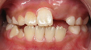 crowding of the teeth before