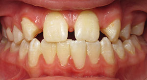 underbite before
