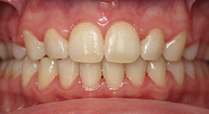 underbite after