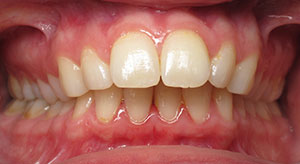 underbite before